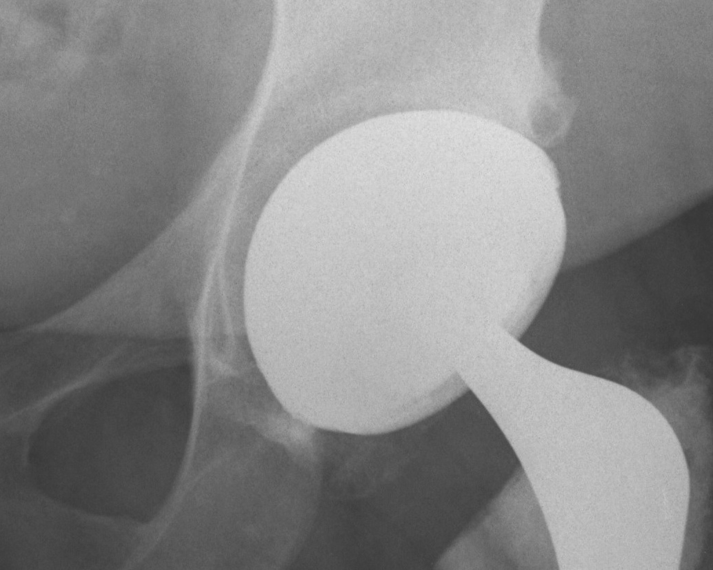 THR Uncemented Cup Superolateral Buttress 2